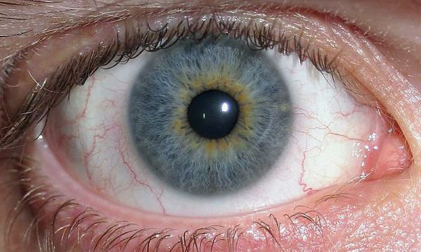 Гетерохромия – глаза разного цвета 2