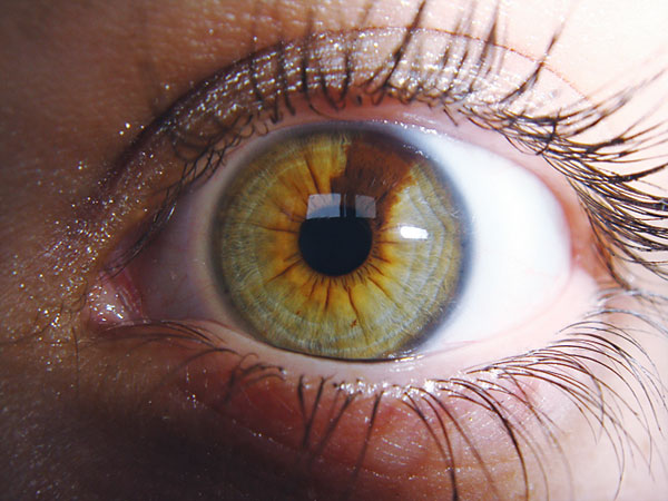 Гетерохромия – глаза разного цвета 1