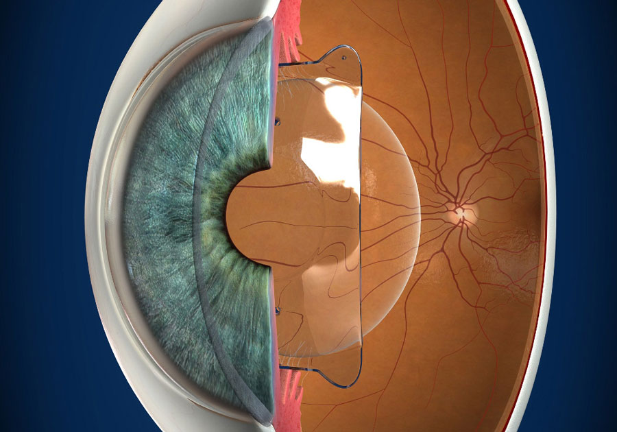 Интраокулярные линзы – помощь глазам, когда очки и лазер бессильны
