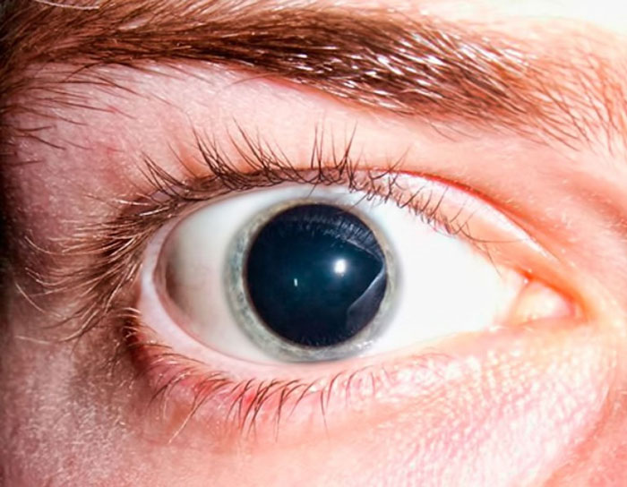 Когда радужка не в порядке, и мир вокруг нерадужный