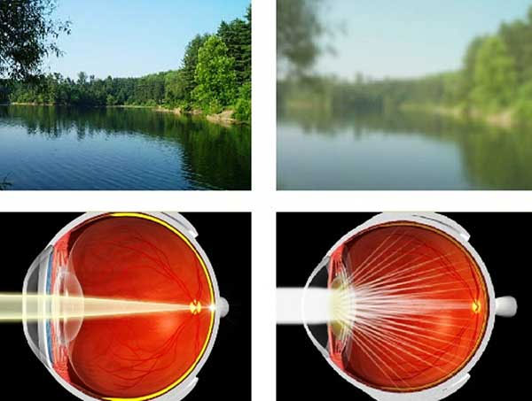 Затуманивание зрения – повод серьезно отнестись к здоровью глаз