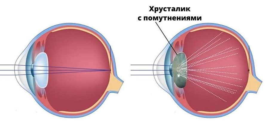 Cataract0.jpg