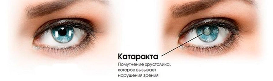 Cataract1.jpg